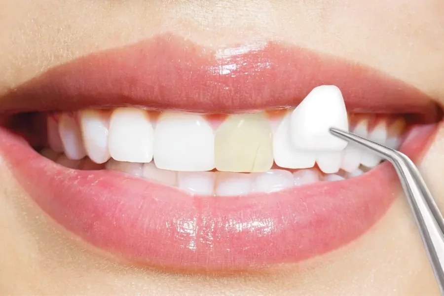 Veneers