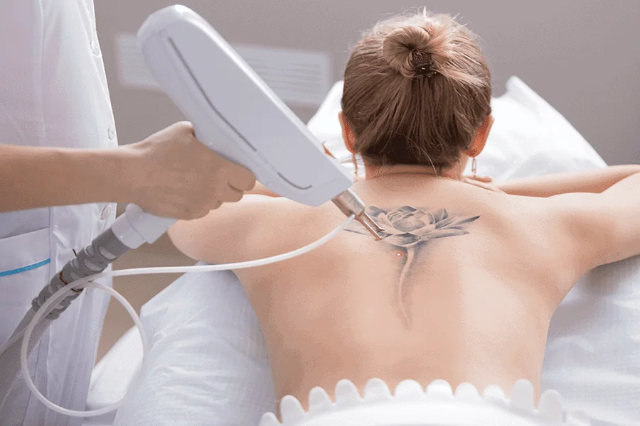 Top 5 Tips for Getting the Best Tattoo Removal Results