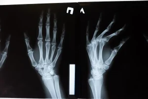 The Importance of Early Treatment for Bone and Joint Problems