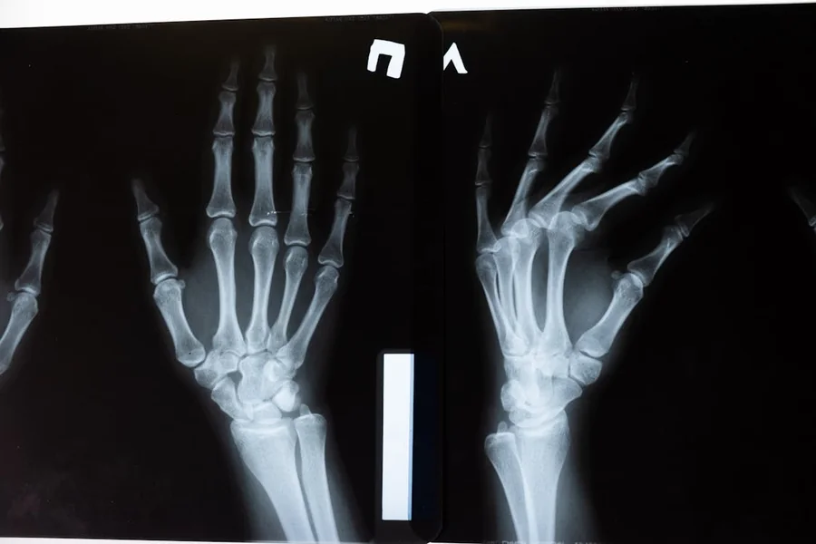 The Importance of Early Treatment for Bone and Joint Problems